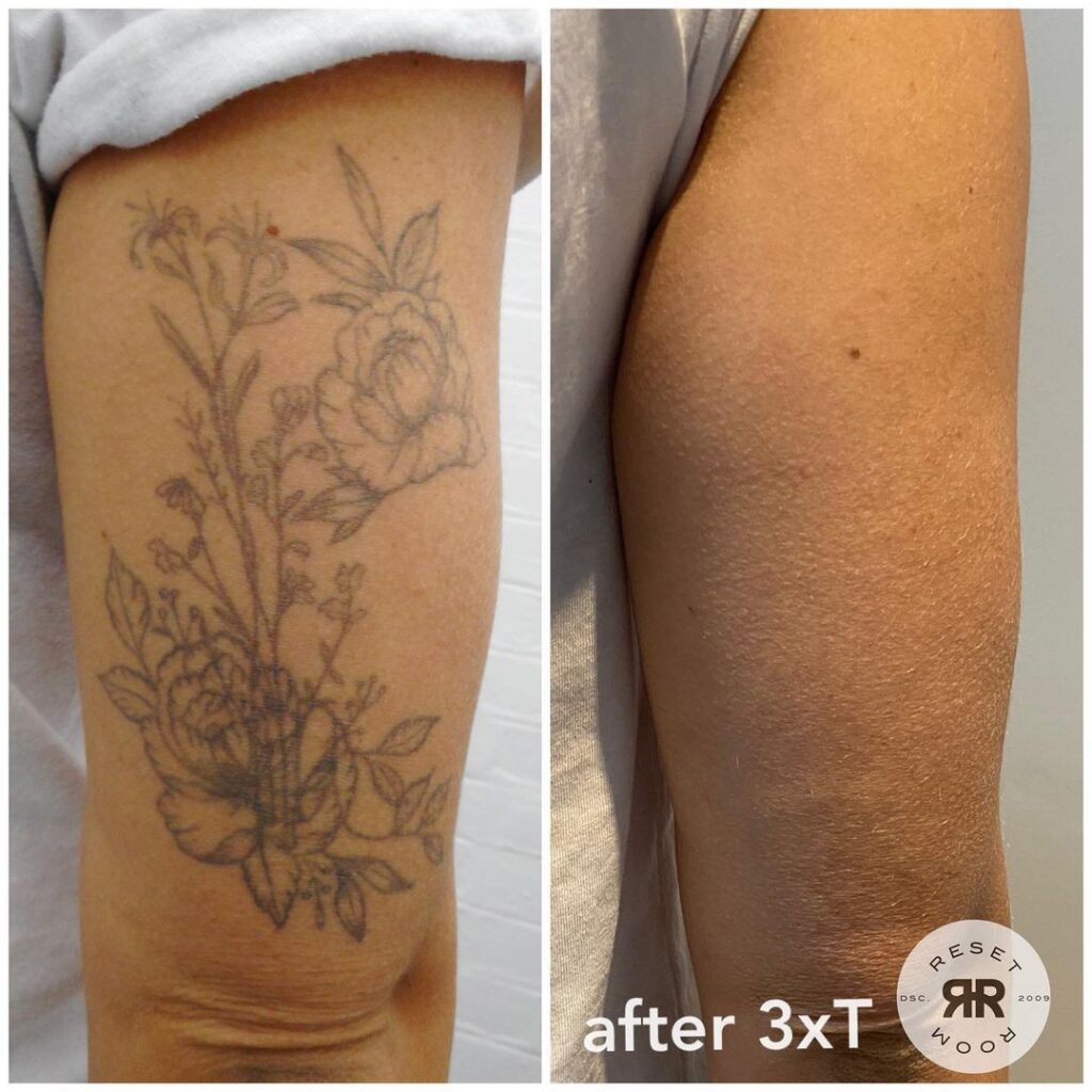A before and after collage. The before images shows the back of an arm which has a faint floral tattoo showing peonies and leaves. The after picture shows the same arm after three removal sessions and the tattoo is no longer visible. 