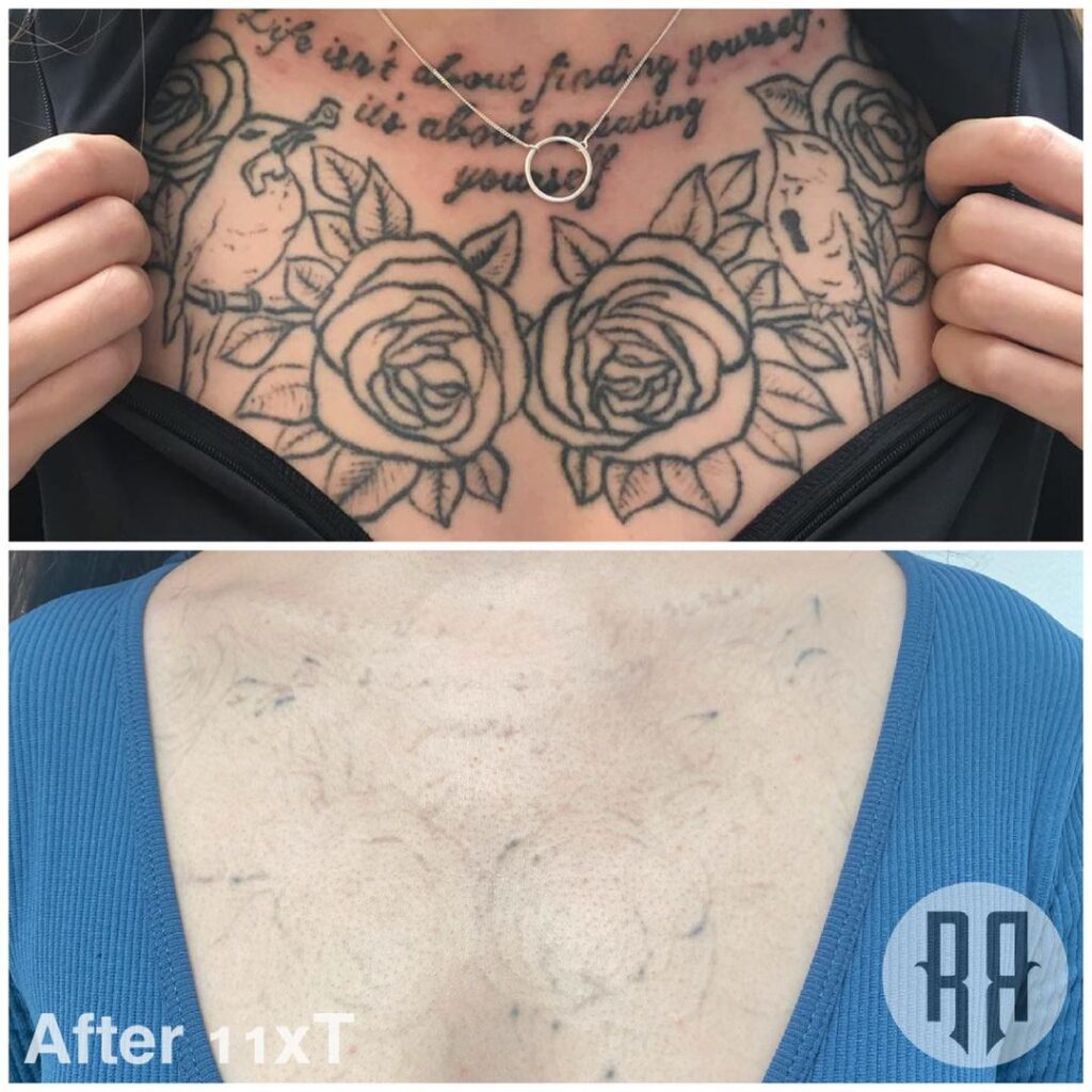  A woman's chest tattoo showing text, black outlined roses and two birds., one holding a key, the other with a keyhole in its chest. The after images shows the same lady's chest after 11 sessions of laser tattoo removal. The tattoo is now very faint but there are still some lines visible on the chest. 